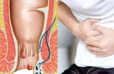 Laser Fistula Surgery Cost in Guindy