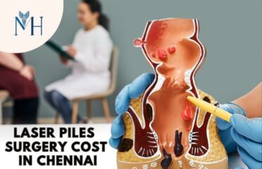 Laser Piles Surgery Cost in Chennai