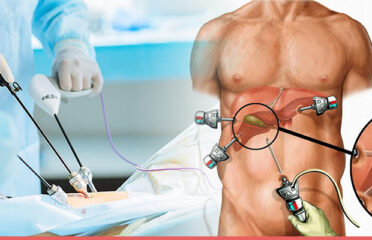 Laparoscopic Gallbladder Surgery Cost in Kilpauk